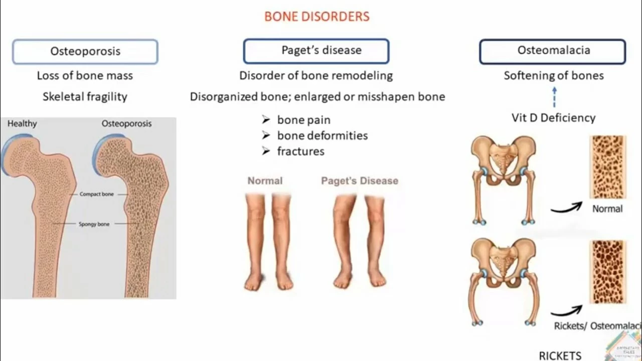 The Importance of Bone Density Testing in Paget's Disease Management