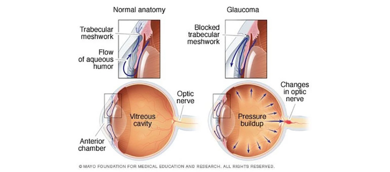 The Importance of Glaucoma Awareness: Educating the Public on Open-Angle Glaucoma