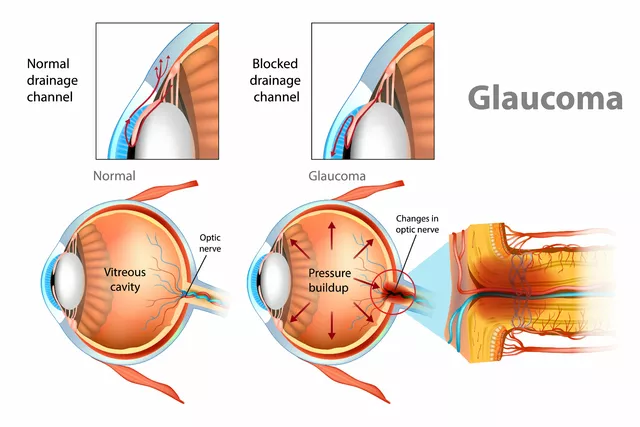 The Importance of Glaucoma Awareness: Educating the Public on Open-Angle Glaucoma